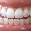 Top 5 Dental Insurance That Covers Invisalign