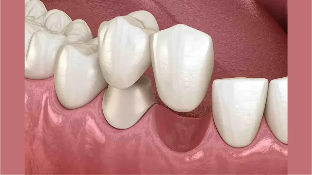 Cantilever Bridge Dental