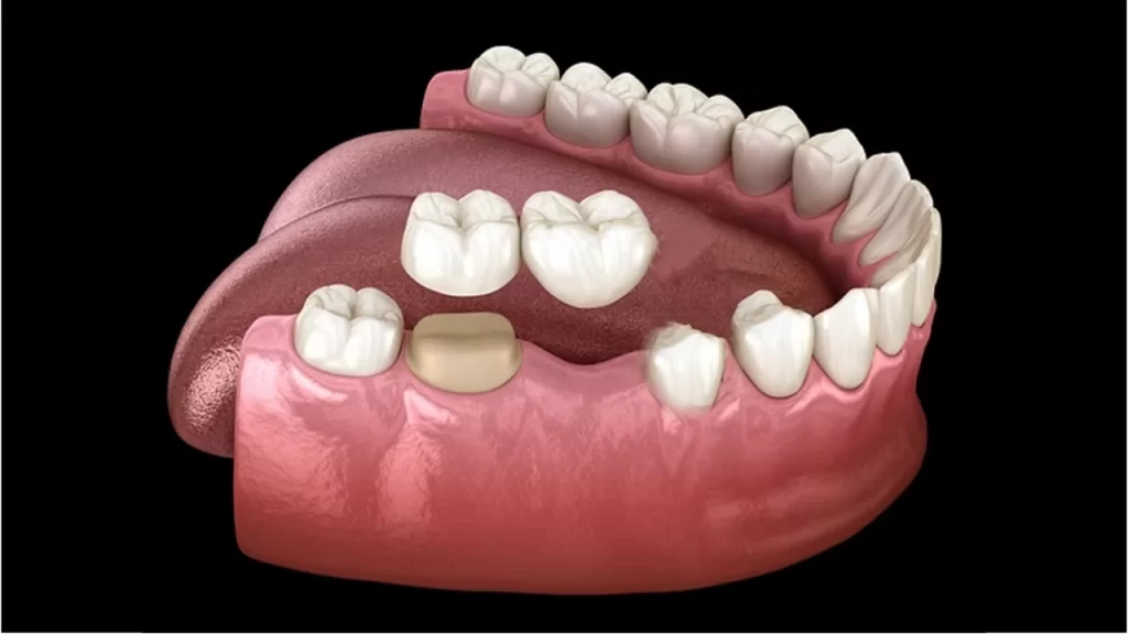Cantilever Bridge Dental