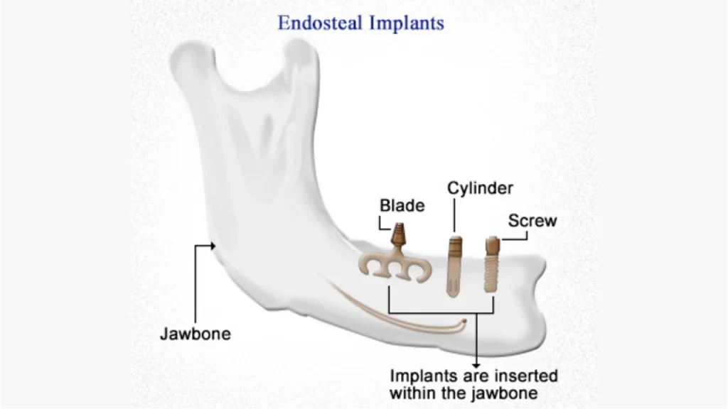 Endosteal implants