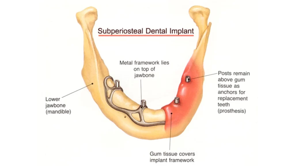 Subperiosteal implant