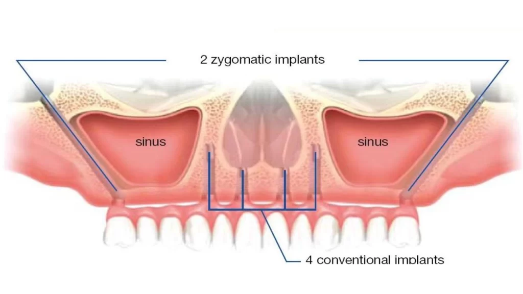 Zygomatic Implant