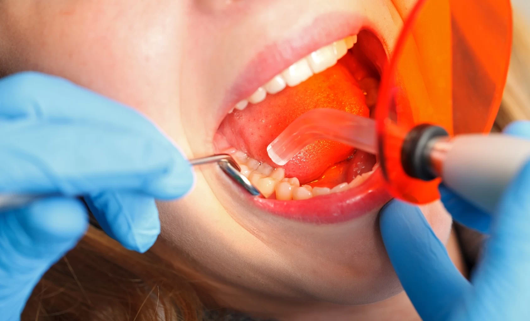 How Long Does Numbness Last After Dental Filling