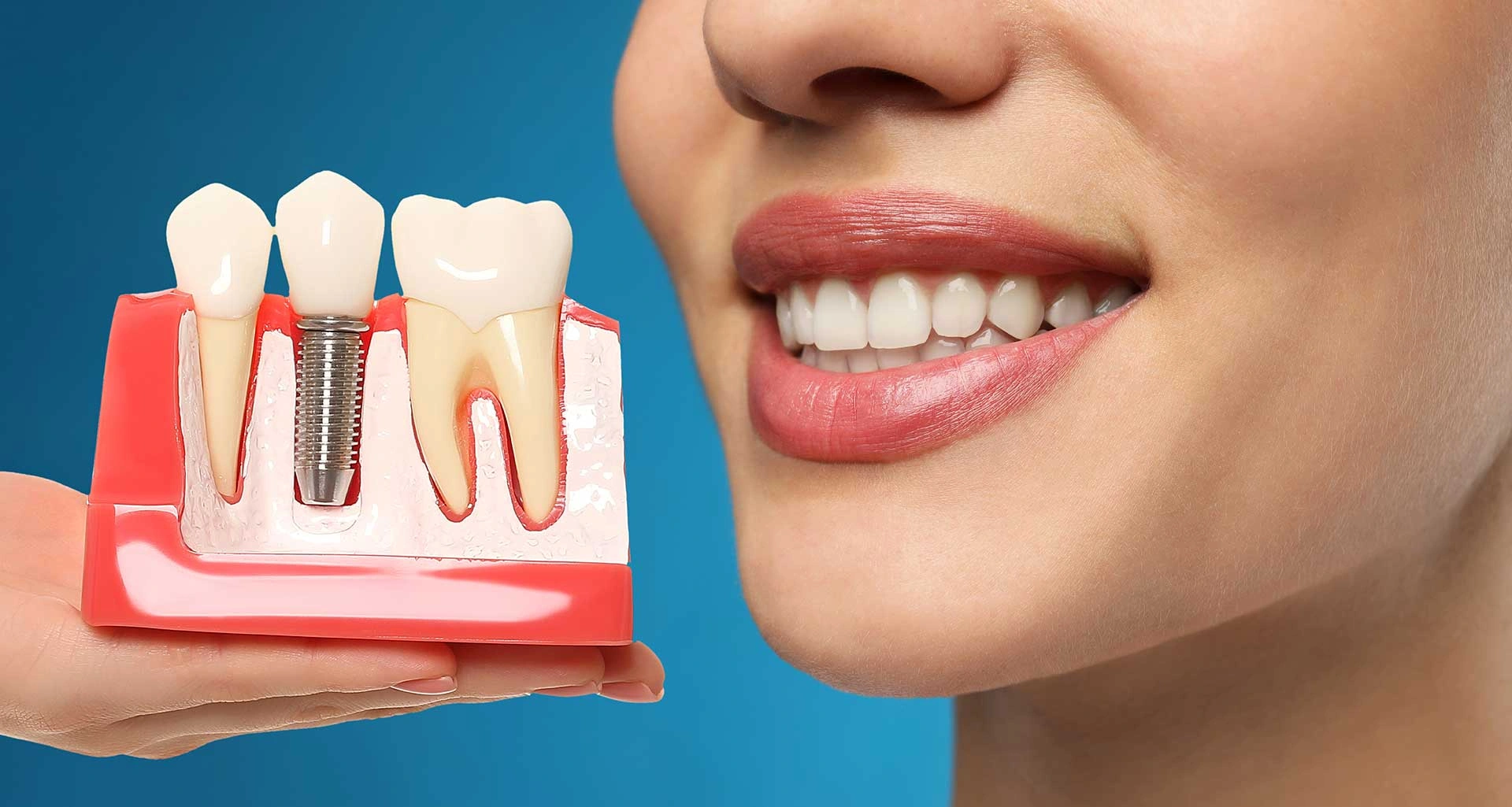 8 Signs That You Need Dental Implants