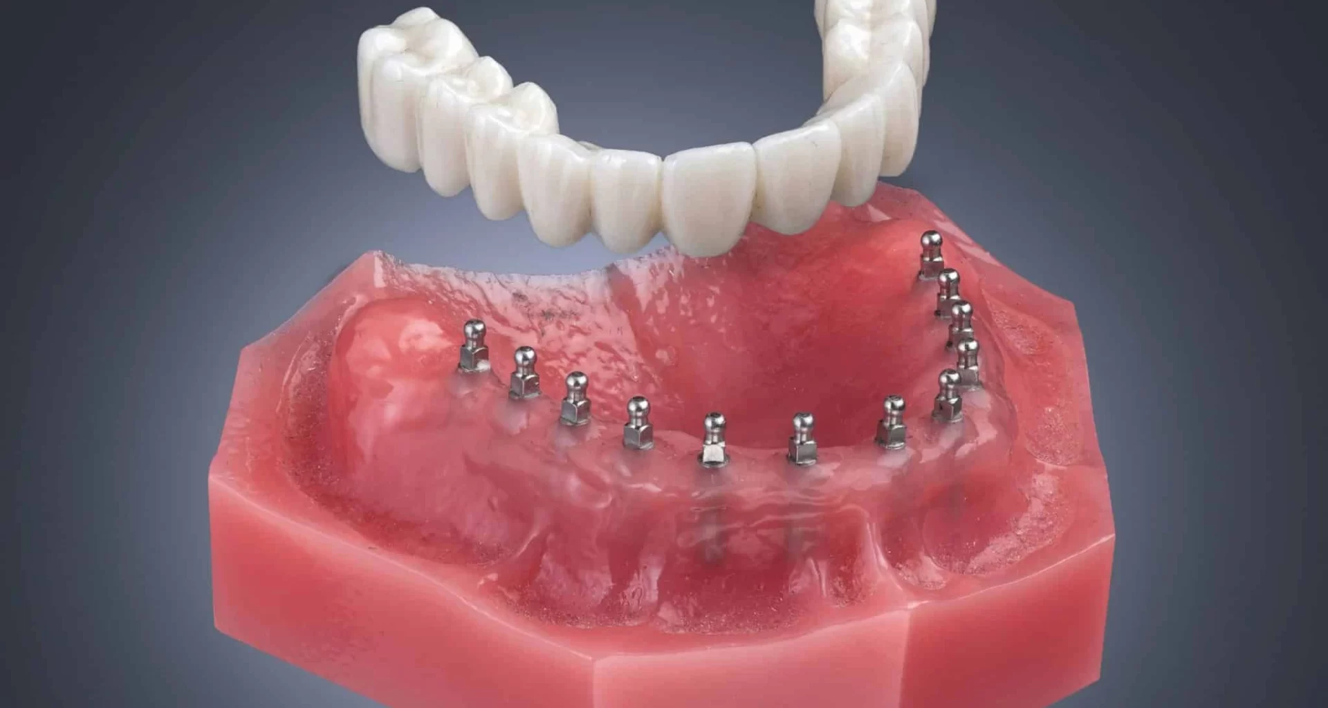 All-on-4 Dental Implants Price in 2025