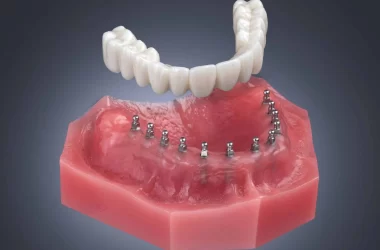 All-on-4 Dental Implants Price in 2025