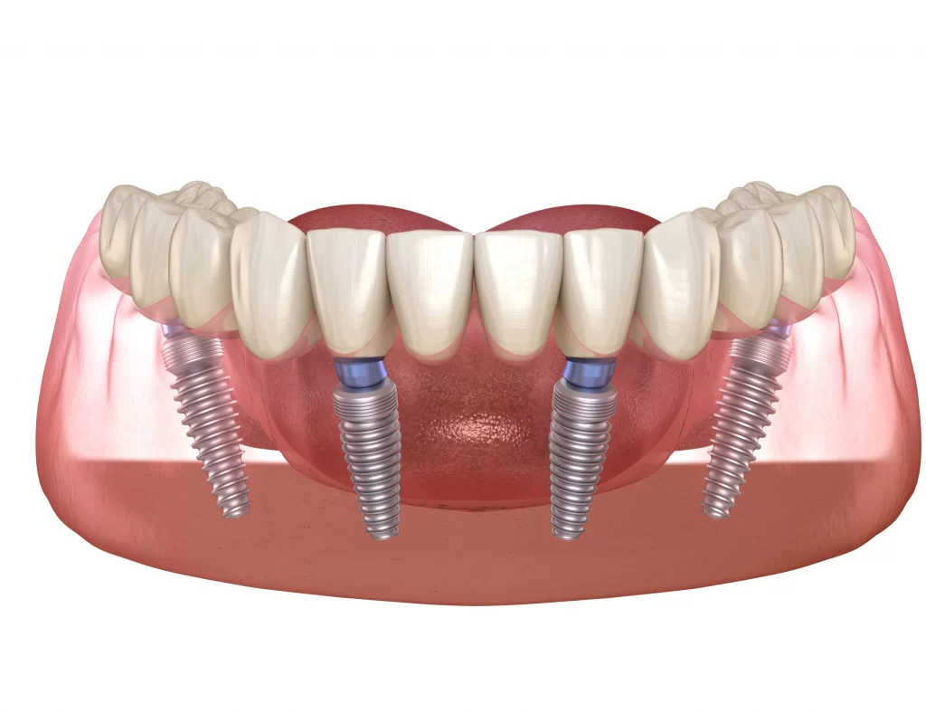 All-on-4 Dental Implants Price in 2025
