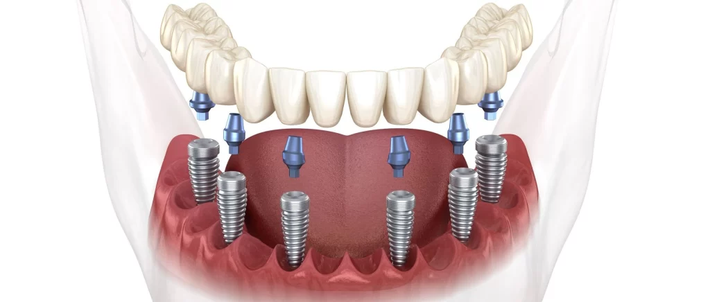 Full Arch Dental Implants: Benefits, Drawbacks, Cost, Procedures - Good ...
