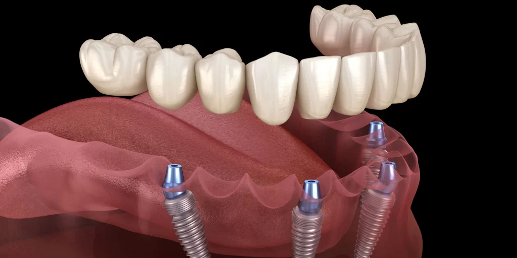 Full Arch Dental Implants: Benefits, Drawbacks, Cost, Procedures - Good ...