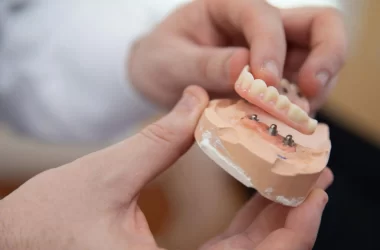 Full Arch Dental Implants