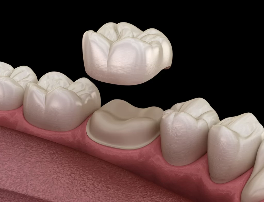 Dental Implant Crown